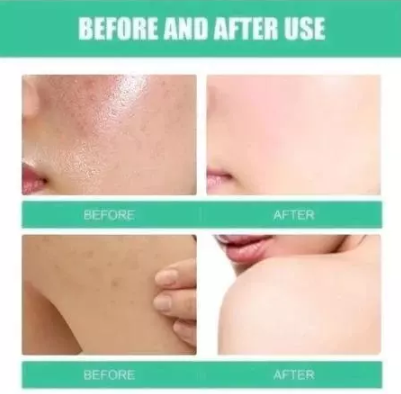 kormesic 5in1 intense acne solution night cream 50g/pelembab wajah kormesic 5in1 intense acne solution night cream 50g/pelembab wajah
