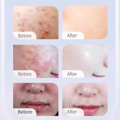 kormesic 5in1 intense acne solution night cream 50g/pelembab wajah kormesic 5in1 intense acne solution night cream 50g/pelembab wajah