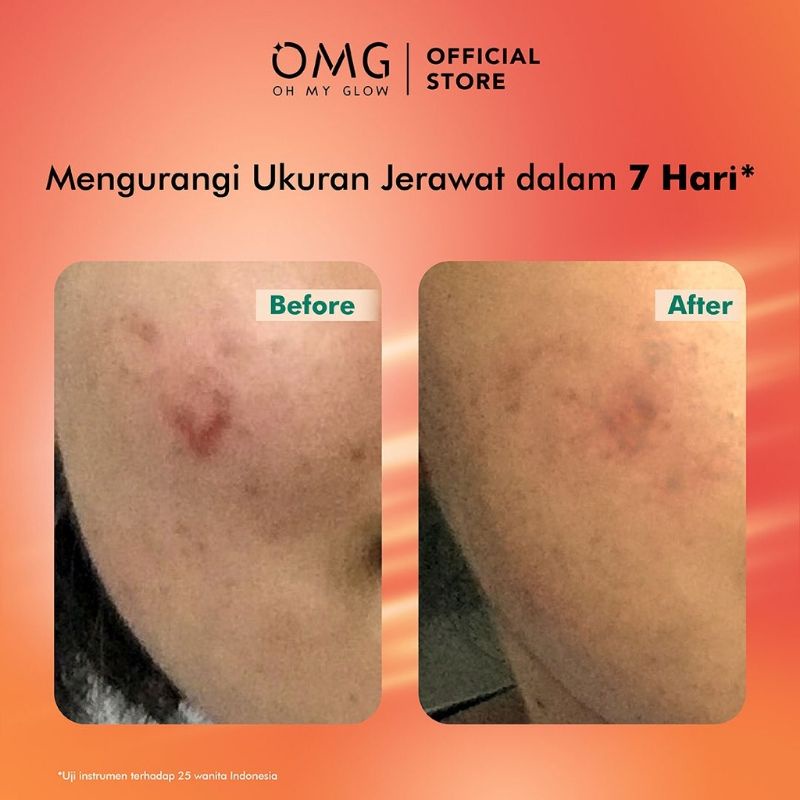 omg oh my glow peach glowing serum & mugwort acne serum 20ml omg oh my glow peach glowing serum & mugwort acne serum 20ml