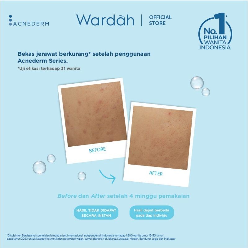 wardah acnederm acne spot treatment gel 15ml | obat totol jerawat wardah acnederm acne spot treatment gel 15ml | obat totol jerawat